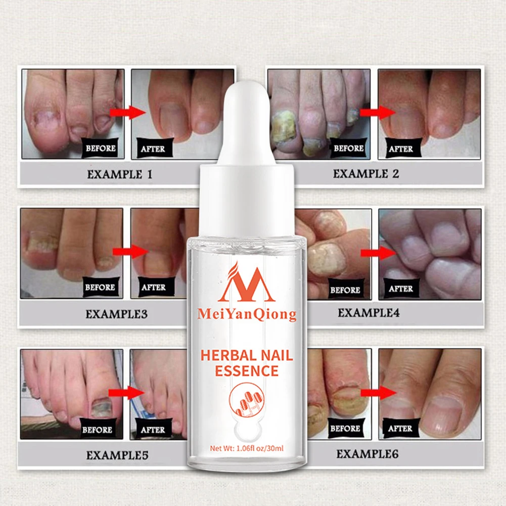 30ml Herbal Toenail Repair Essence Anti Infection Foot Care Serum Effective Toe Nails Fungal Removal Gel for Women Men