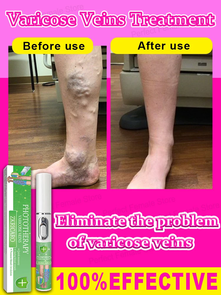 vein laser product