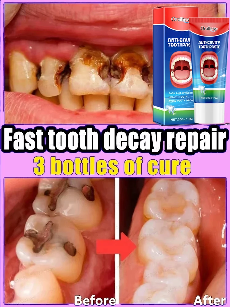 Tooth decay Repair Repairing Cavities Anti Protecting Caries