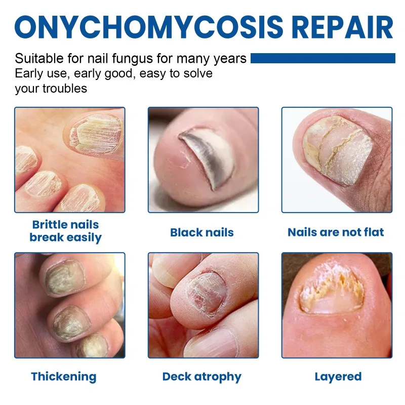 لاصقة إصلاح فطار الأظافر لأظافر القدم ، إزالة الفطريات ، مكافحة العدوى ، تلف الداحس ، العناية بالأظافر ، العلاج الفطري ، الملصق