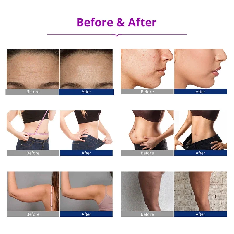 5in1 สามเสา RF กระชับผิวสูญญากาศ 40K Cavitation อัลตราโซนิกเซลลี่สลิมมิ่งสปาเครื่อง 190W