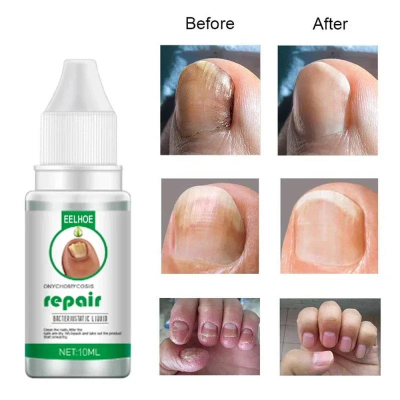 Nail Fungus Treatment Serum Repair Fungus Removal Essence Liquid Onychomycosis Foot Care Gel Anti Infection Thicken Soft Nails