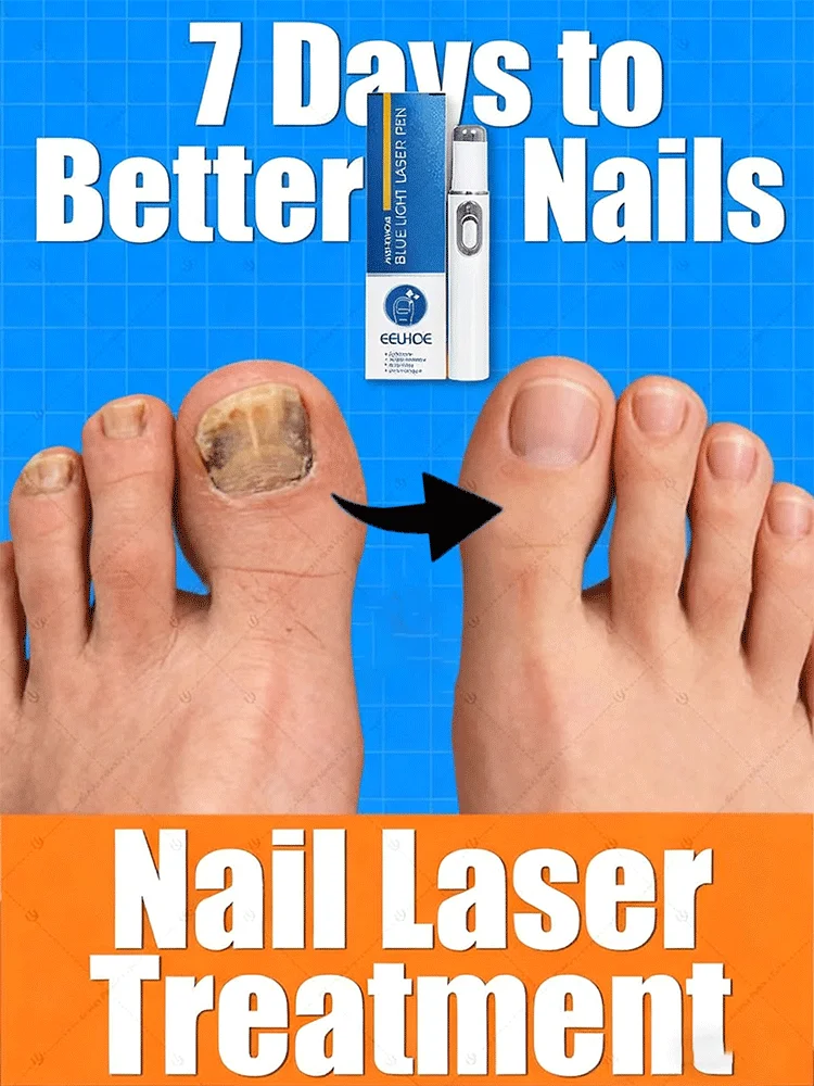 

Fungus nail laser pointer helps to get rid of onychomycosis gray nail Painless and long-lasting sterilization anti-recurrence