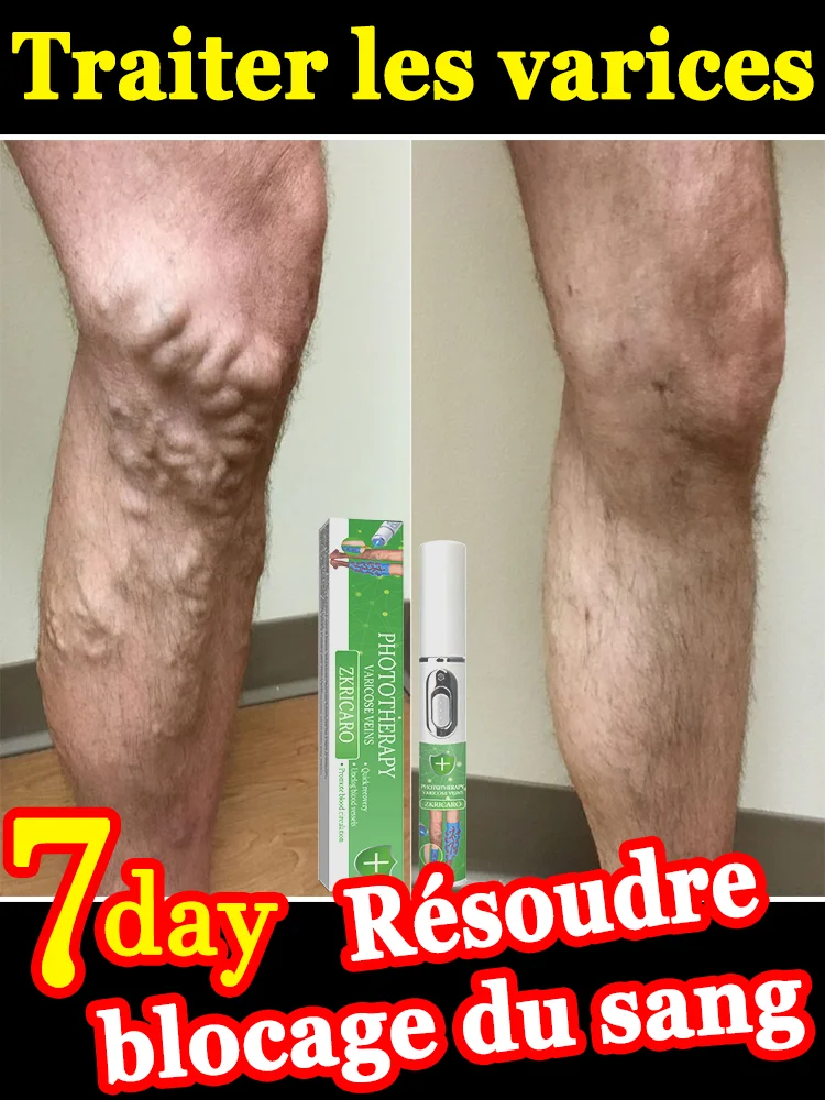 laser,Débarrassez-vous des varices
