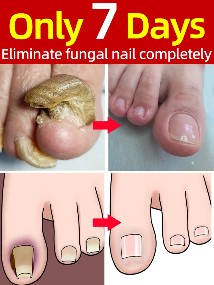 

Solving the nail problems