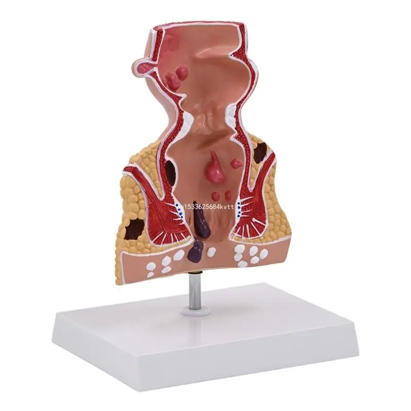 

Human Anatomy Model Human Pathologies of Rectum Model School Teaching Supplies Dropship