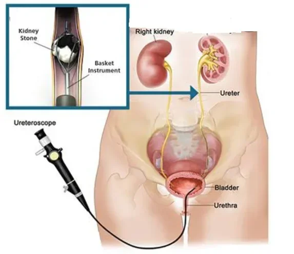 Surgical Urology Endoscope Dormia Stone Retrieval Basket Spiral Working Length 590mm