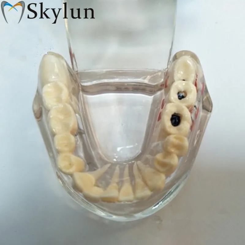 Dental tooth model active tooth pathology model detachable 11 teeth model dental material SL722