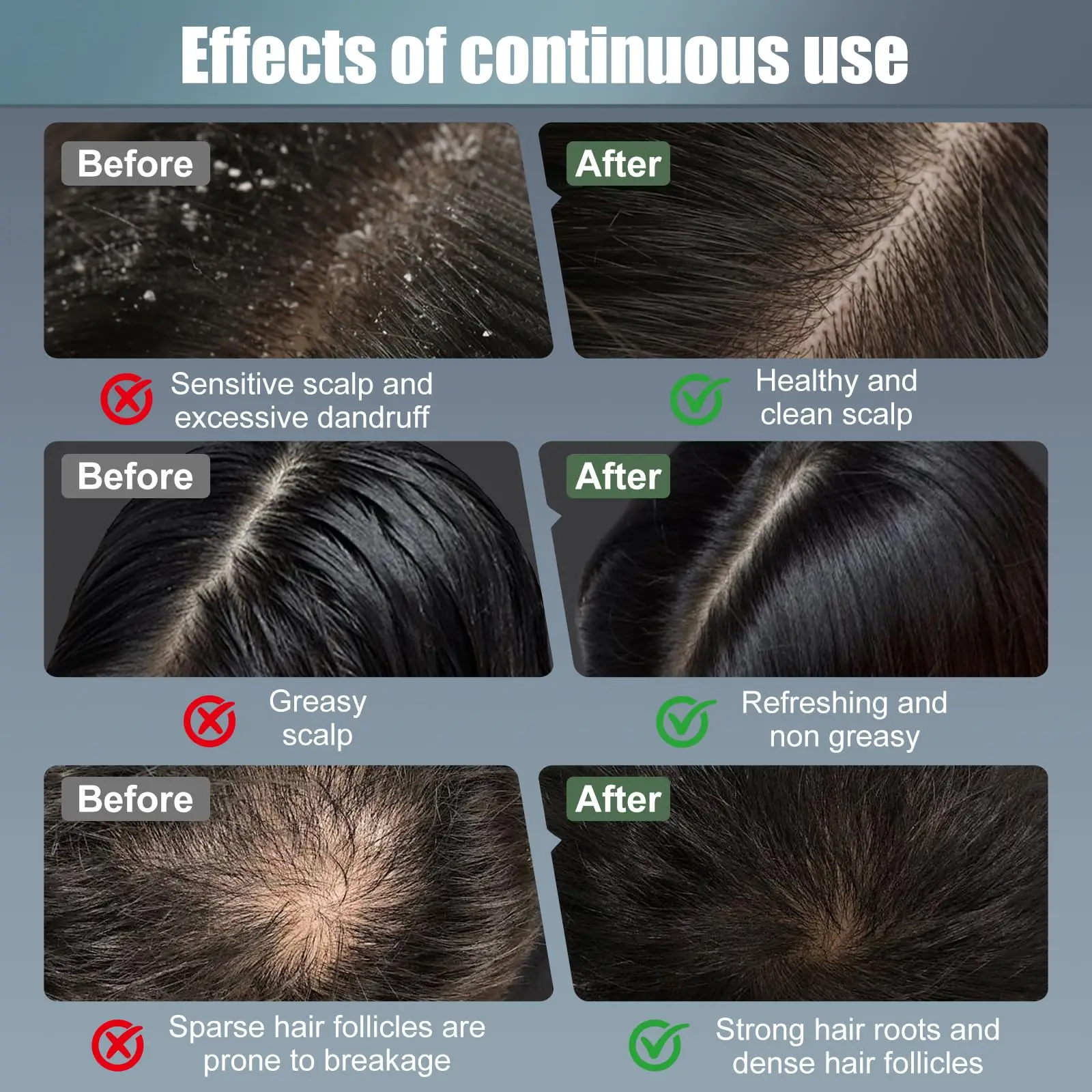 مشط العلاج بالليزر لنمو الشعر، العلاج بالضوء الأحمر لنمو الشعر، فرشاة العلاج، فرشاة العلاج لنمو الشعر