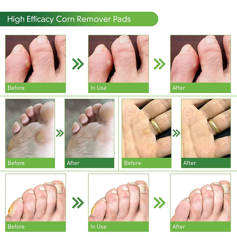 Pexmen 1/2/5/10Pcs Corn Remover Traditional Ingredients to Removes Corns Fast Corn Removers for Toes Pads Foot Care Tool