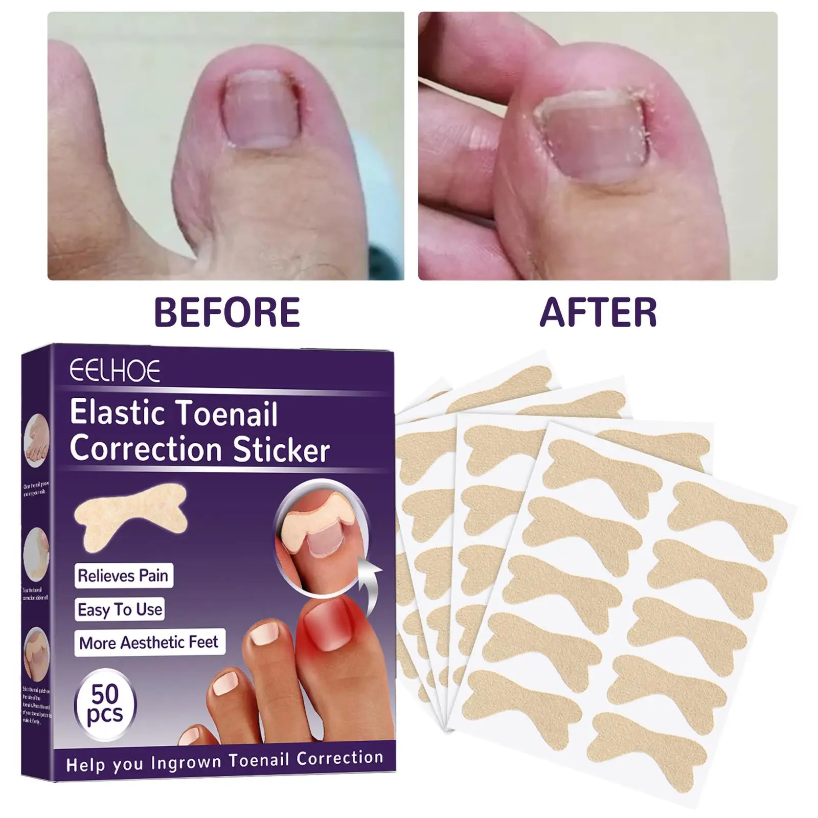 50Pcs Toenail Corrector Patch Glue Free Pedicure Tools Curved Professional Ingrown Toenail Sticker for Toe Nail Women Men