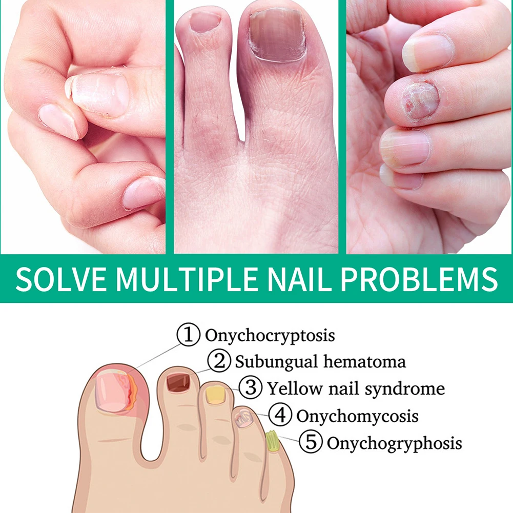 Nail Repair Fluids Fingernails Renewal Liquid For Nail Toenail