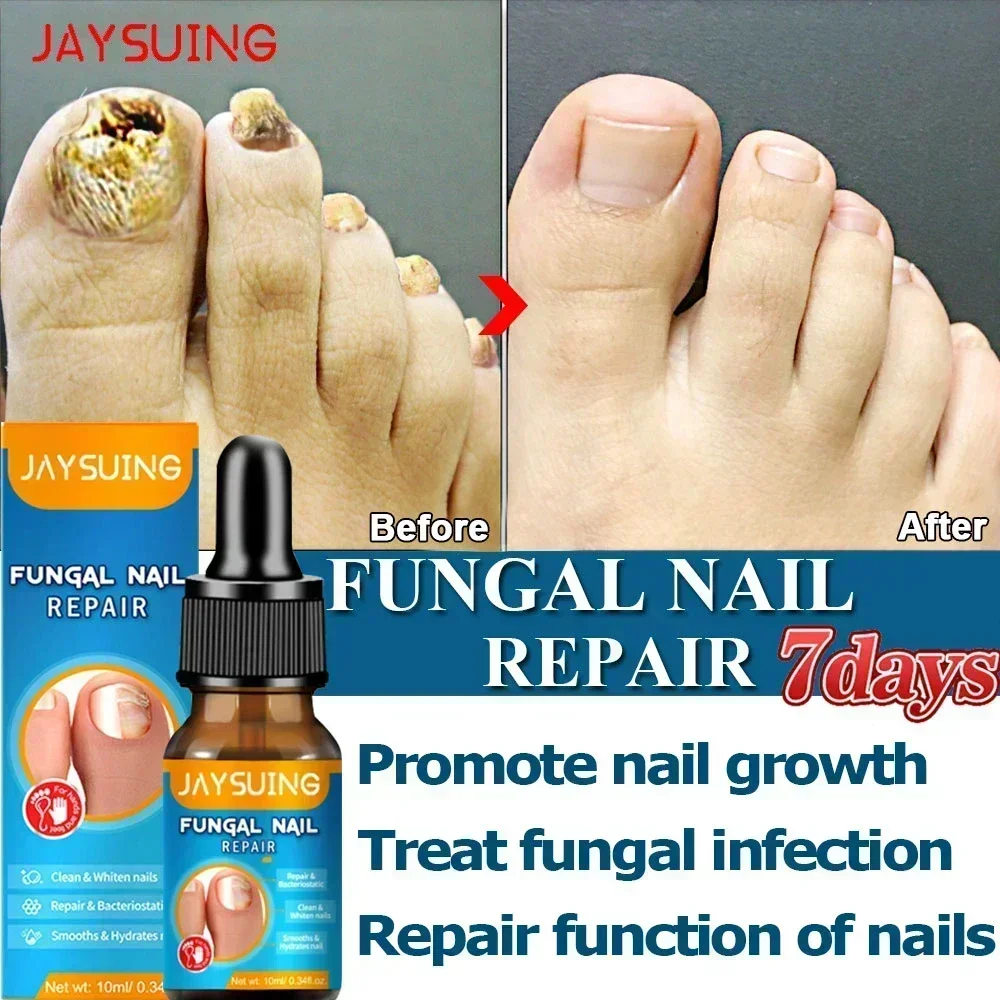 Aceite para tratamiento de uñas fungicida, esencia para reparación de pies, Gel para eliminación de hongos en las uñas de los pies, crema antiinfección, 10ML0903