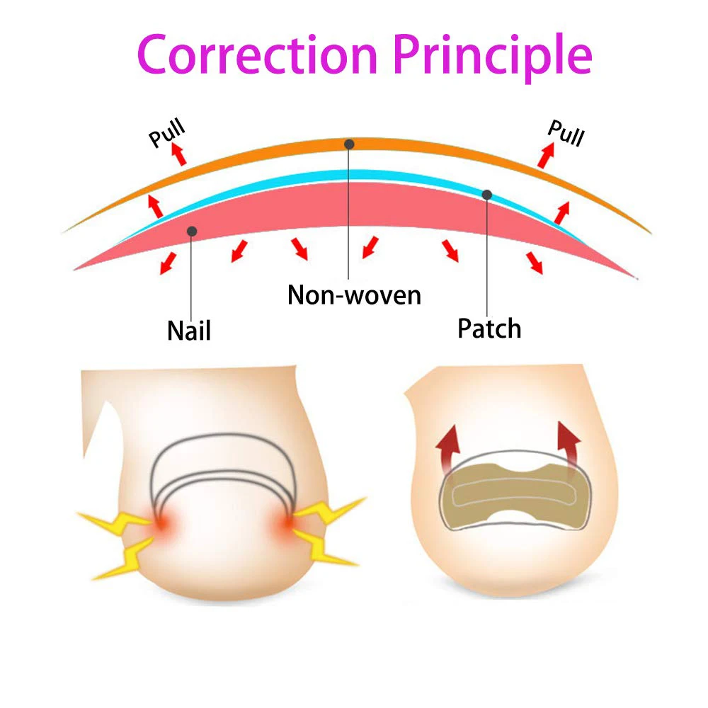 50/100pcs Ingrown Toenail Corrector Patches Nail Correction Care Stickers Paronychia Treatment Recover Corrector Pedicure Tool