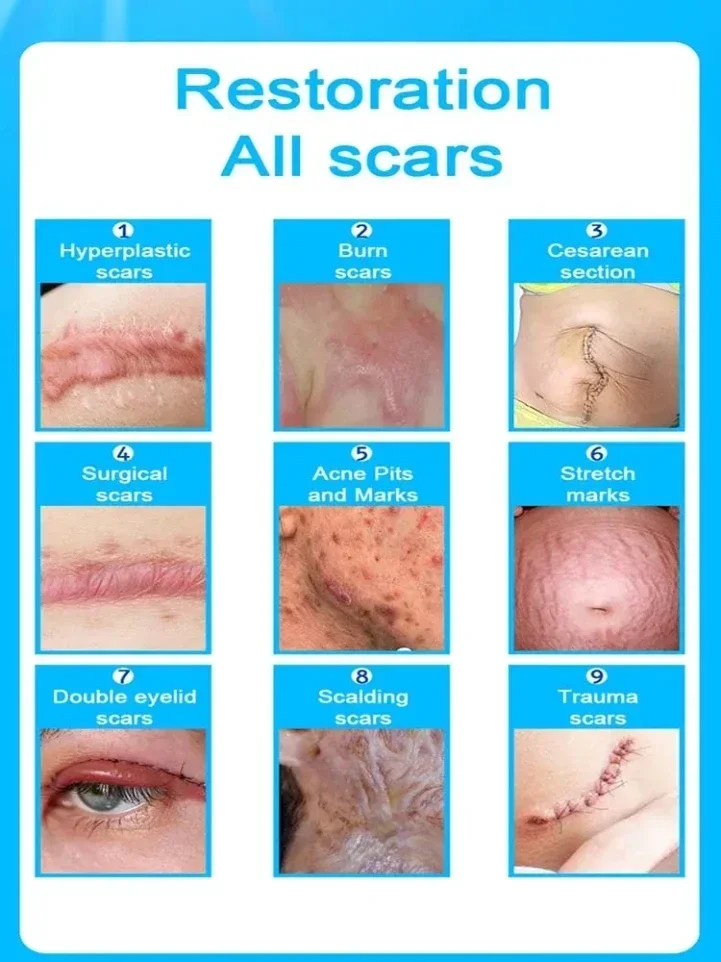 Effective for Old & New Scars on Face & Body| Pen for scars| Laser therapy Keloid scar|