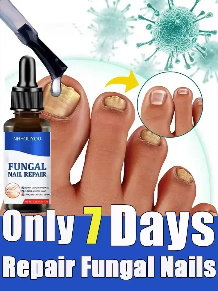 Toenail Nail Fungus Treatment Repair Fingernail Device trattamento dell'unghia del piede fungo del chiodo olio essenziale onicomicosi cura