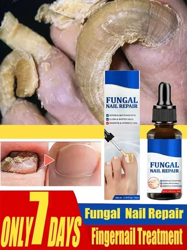 Soro para tratamento de fungos nas unhas, produtos para reparo de fungos dos pés, gel para remoção de cuidados com as mãos e pés, anti-infecção, paroníquia, onicomicose