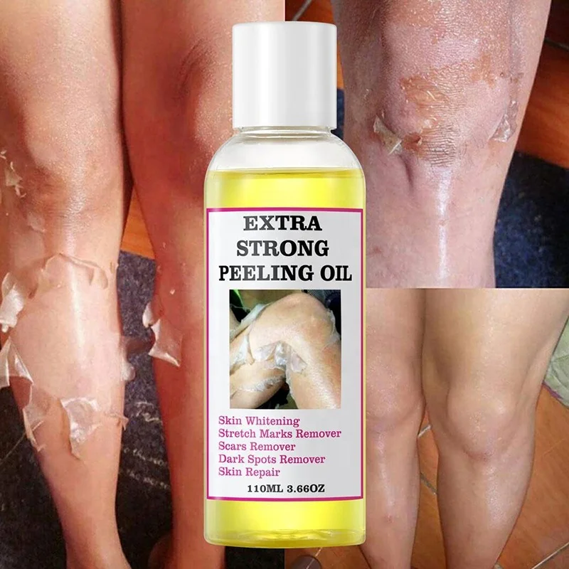 Super Strength Green And Yellow Peeling Oil Lighten Elbows Knees Hands Melanin Bleaching Dark Skin Strong Peeling Oil