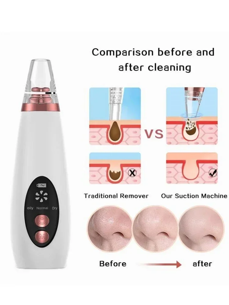 Rimozione dell'acne ed esportazione di punti neri Detergente per il viso Dispositivo di bellezza elettrico Pulizia visiva e dispositivo di aspirazione dei punti neri Cura della pelle