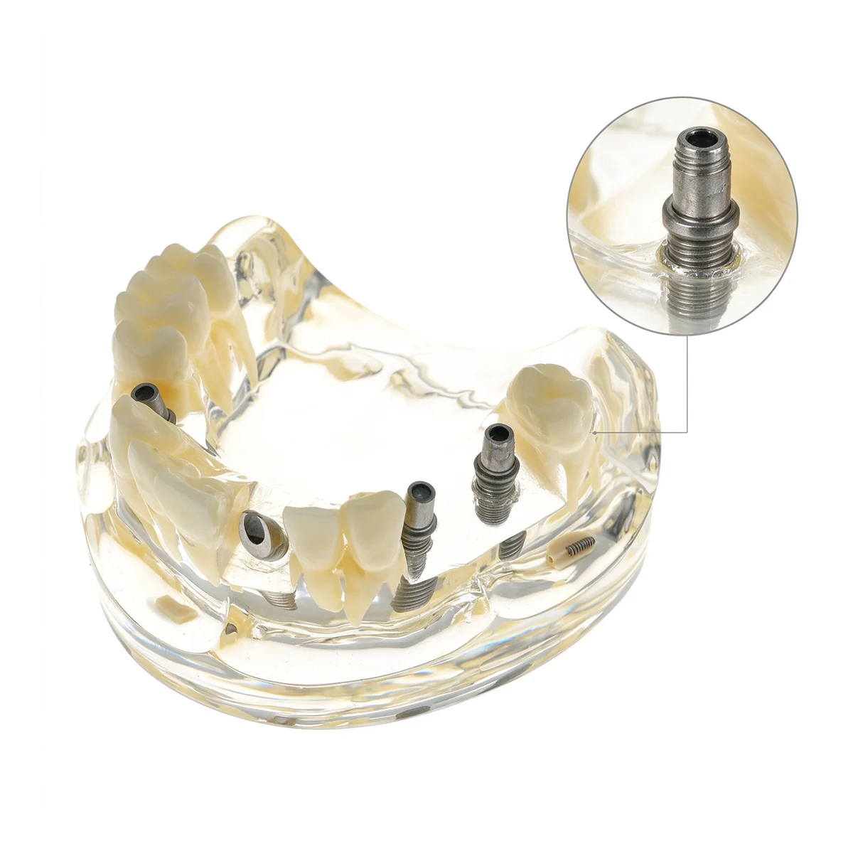 Dental Tooth Model Dental Implant Model Removable Teeth Dentistry Demonstrates Implant Crowns Bridge Models For Studying Demo
