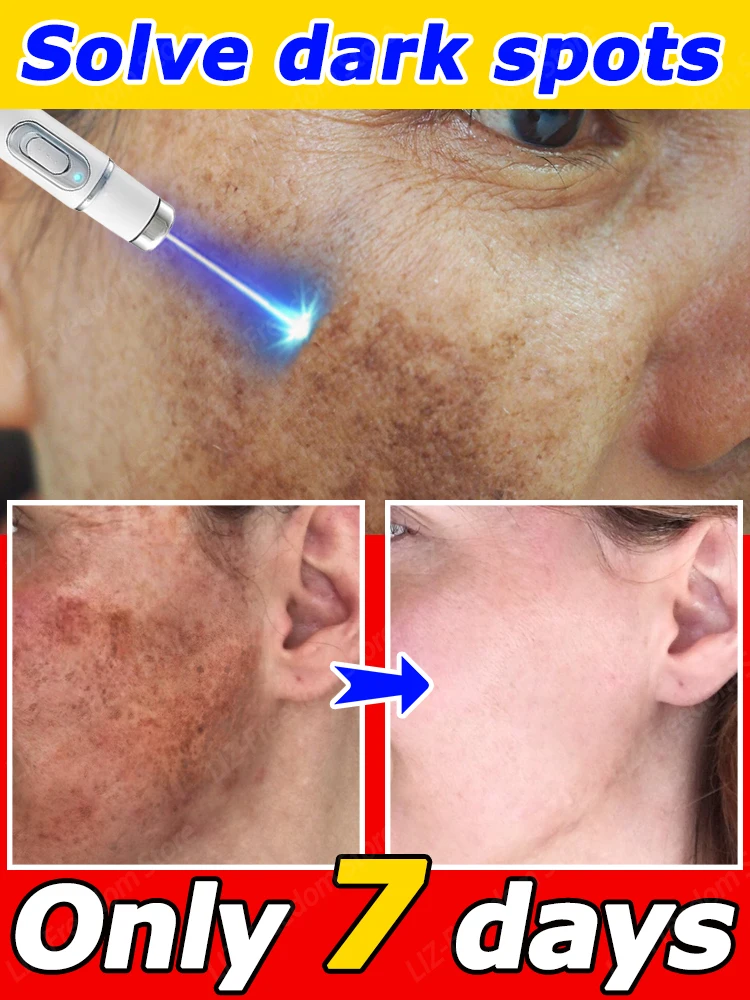 

Freckle highly effective repair facial dark spot