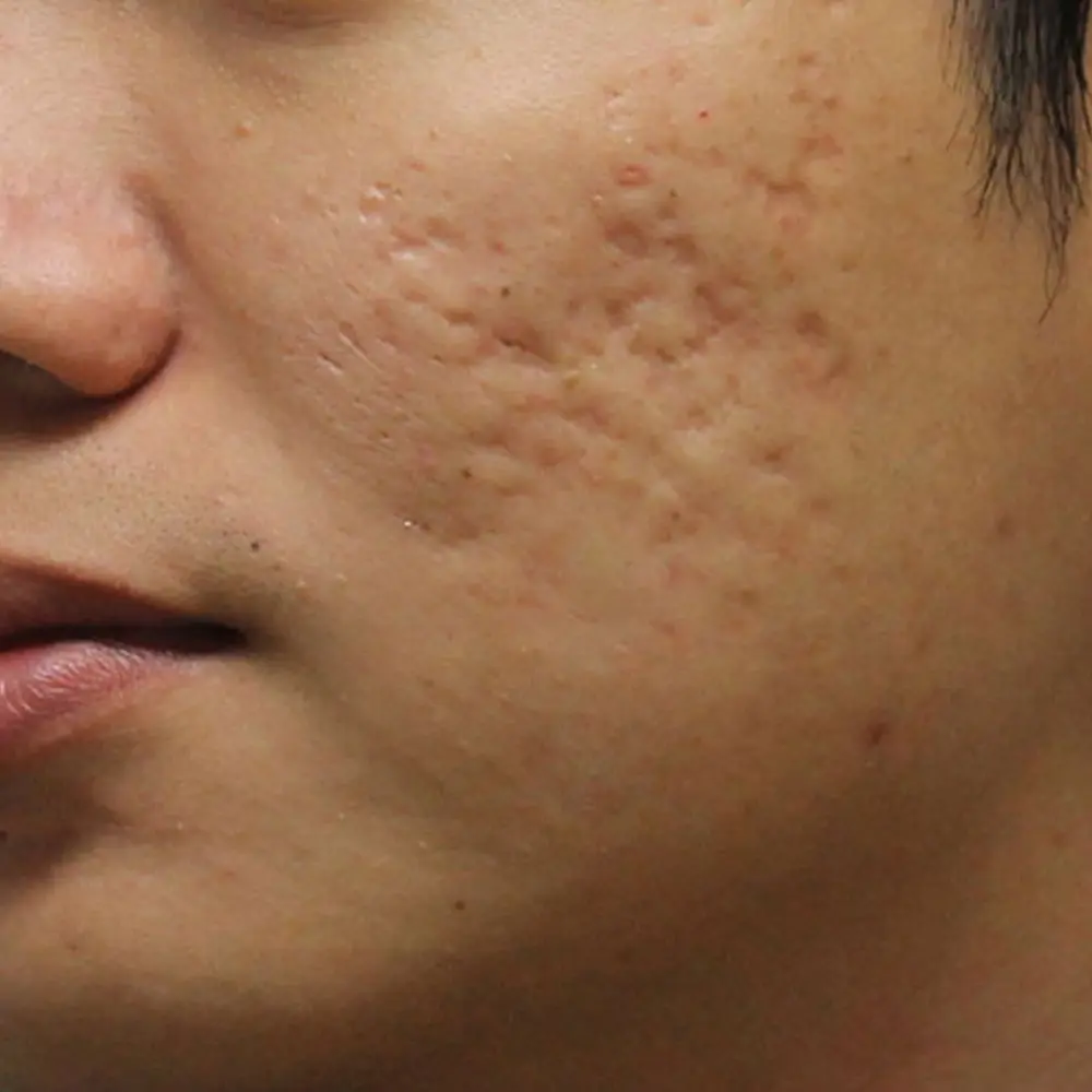 Madecassol-Crema de efecto mágico, bálsamo de Sikatrizan, Centella, regenerador de células asiáticas, acné, granos, lesión, dolor en la piel, rejuvenecimiento de la piel, 40 g