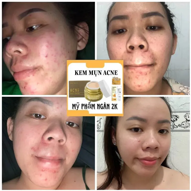 

Kem Face Mụn Linh Chi Tặng Sửa Rửa Mặt Gạo Sữa, Reduce Acne, Black Spots, Moisturize, Brightening Skin，25g/Bottle