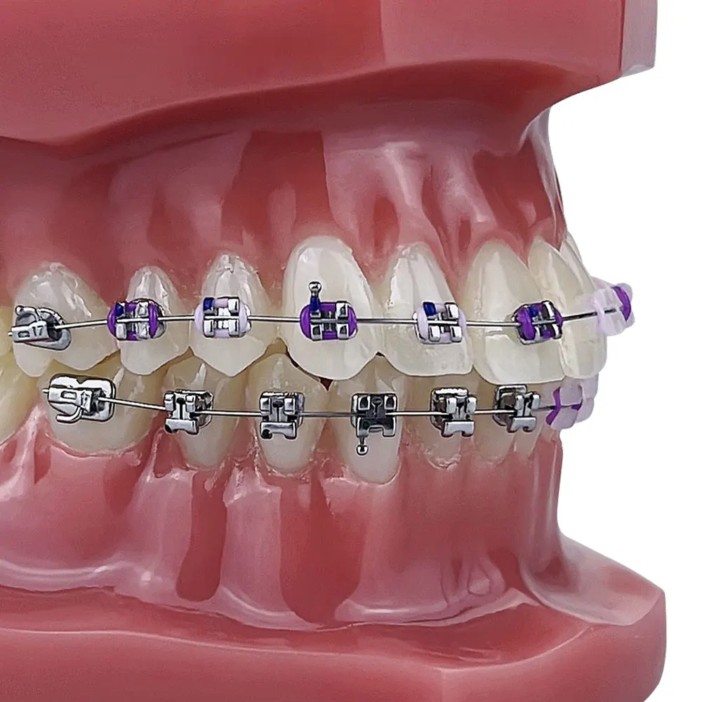 Dental With Braces Bracket Orthodontic Teeth Model Metal/Ceramic Self-Locking Dentistry Treatment for Teaching Studying Demo