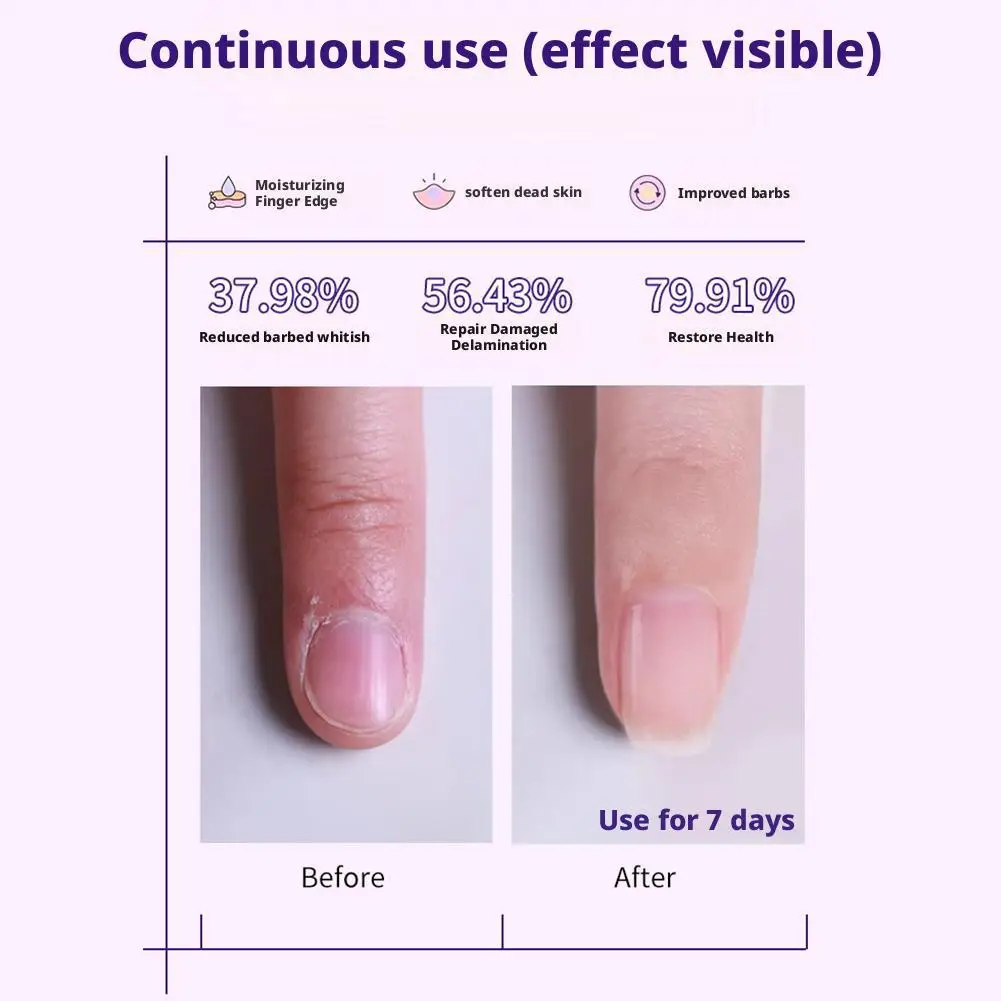 ปากกาดูแลเล็บ 3-in-1 พร้อมหัวเซรามิก น้ำมันบำรุงหนังกำพร้า และแท่งปรับสภาพเล็บ บำรุงเล็บและมือสำหรับเล็บที่งอกขึ้น