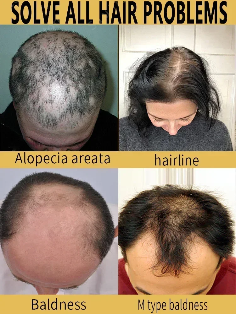 Óleo De Crescimento De Cabelo Para Homens, Biotina Tratamento Rápido, Soro De Calvície