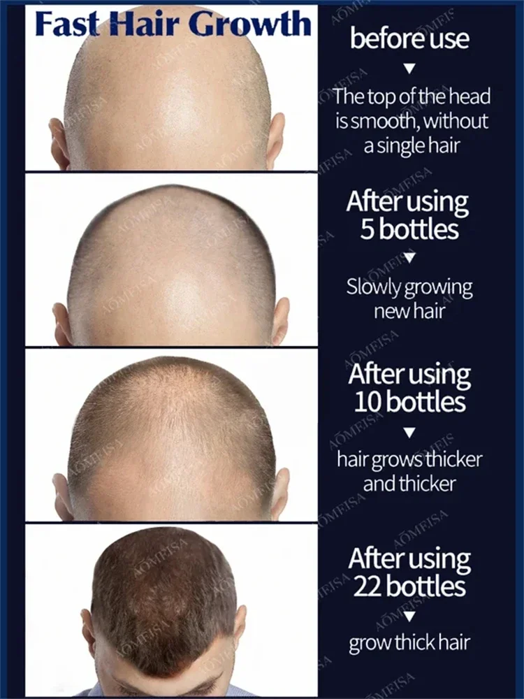 Hot selling product, 99% of buyers buy again, have more and more hair, say goodbye to baldness, thick hair