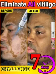 Vitiligo lazer