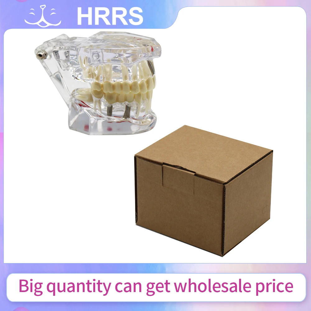 Implant Dental Disease Teeth Model With Restoration Bridge Tooth For Medical Science Dental Disease Teaching Study Tool