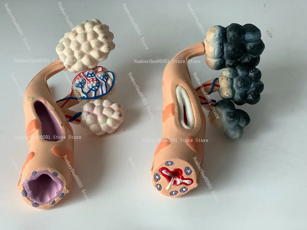 Smoker vs Healthy Lung Alveoli Comparison Model Human Respiratory System Anatomy Teaching Display Medical Pathology