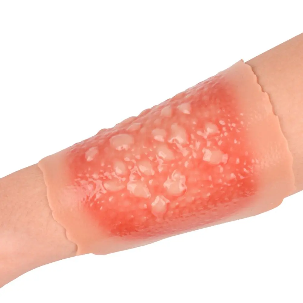 Ultrassist Burn Wound Moulage Model 1st-4th Degree Adhesive Skin Burn Wound Packing Trainer Kit for Medical Students Care Train
