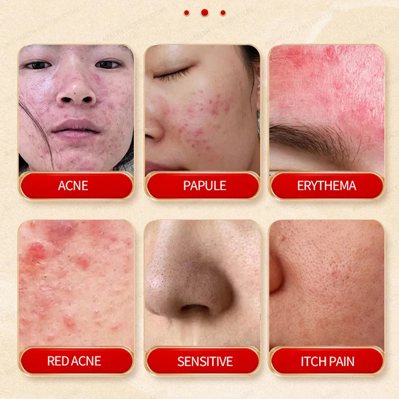 كريم حب الشباب التايلاندي الوردي يهدئ الأنف الأحمر والوجه الأحمر وعدم حب الشباب الأحمر بالدم، كريم العناية الخارجية والعناية الصحية