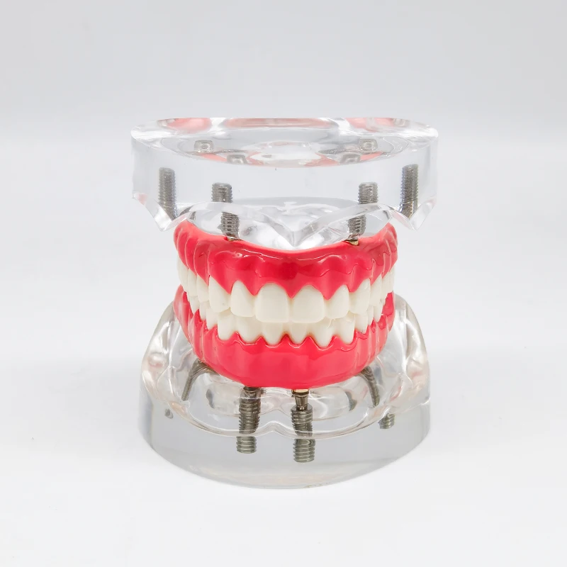 Dental Implant Model Upper/Lower Dental Removable Implant Model with 4 Implants Screws Dental Teaching Demo Model