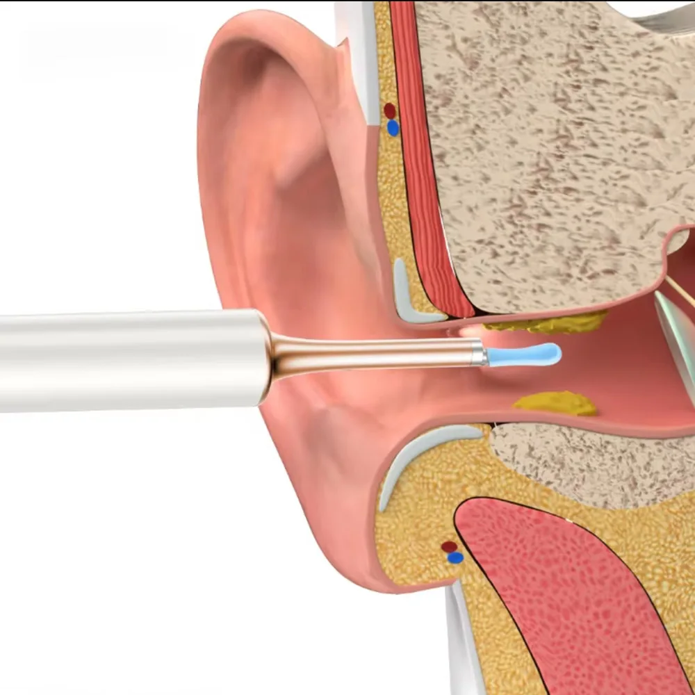 비주얼 귀 클리너 블랙헤드 리무버, 스퀴즈 여드름 바늘, 5MP HD 내시경 카메라, 귀 왁스 제거, 아이폰 안드로이드용 3.5mm 카메라