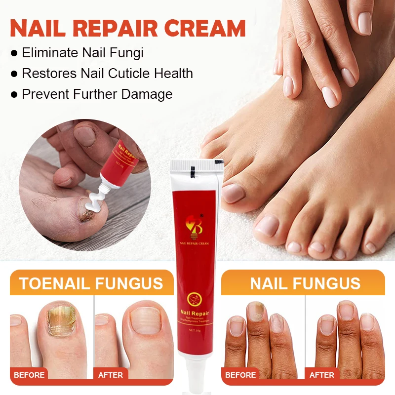 10g Nail Fungus Removal Cream Onychomycosis Fungal Ointment Nail Paronychia Cream Anti Feet Toe Fungal Toenail Care Ointment