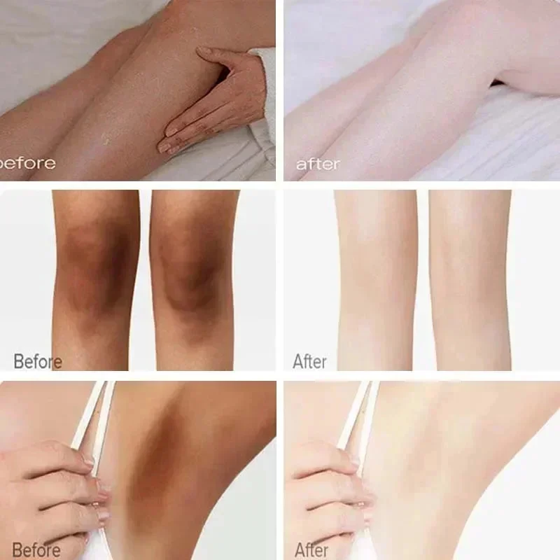 Creme de clareamento corporal, Partes íntimas, axilas, joelho, coxa interna, clareamento de melanina, clarear loção, pele escura, cuidados saudáveis