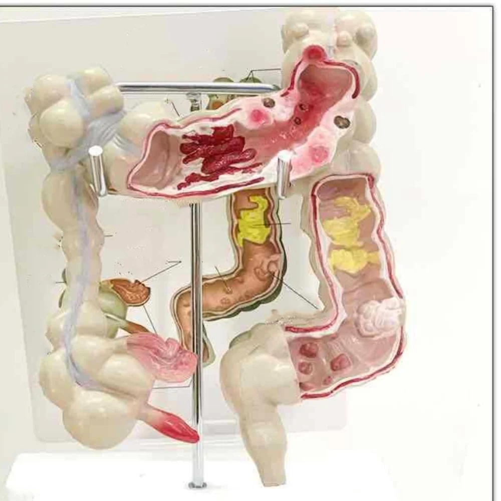 Colonic pathology model Intestinal disease human colonic lesion model