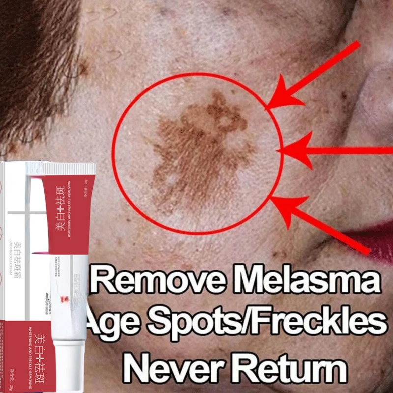 Freckle Whitening Cream Black Dots Melasma Remover Anti Brown Stain Lighten Pigmentation Moisturizing Skin Care