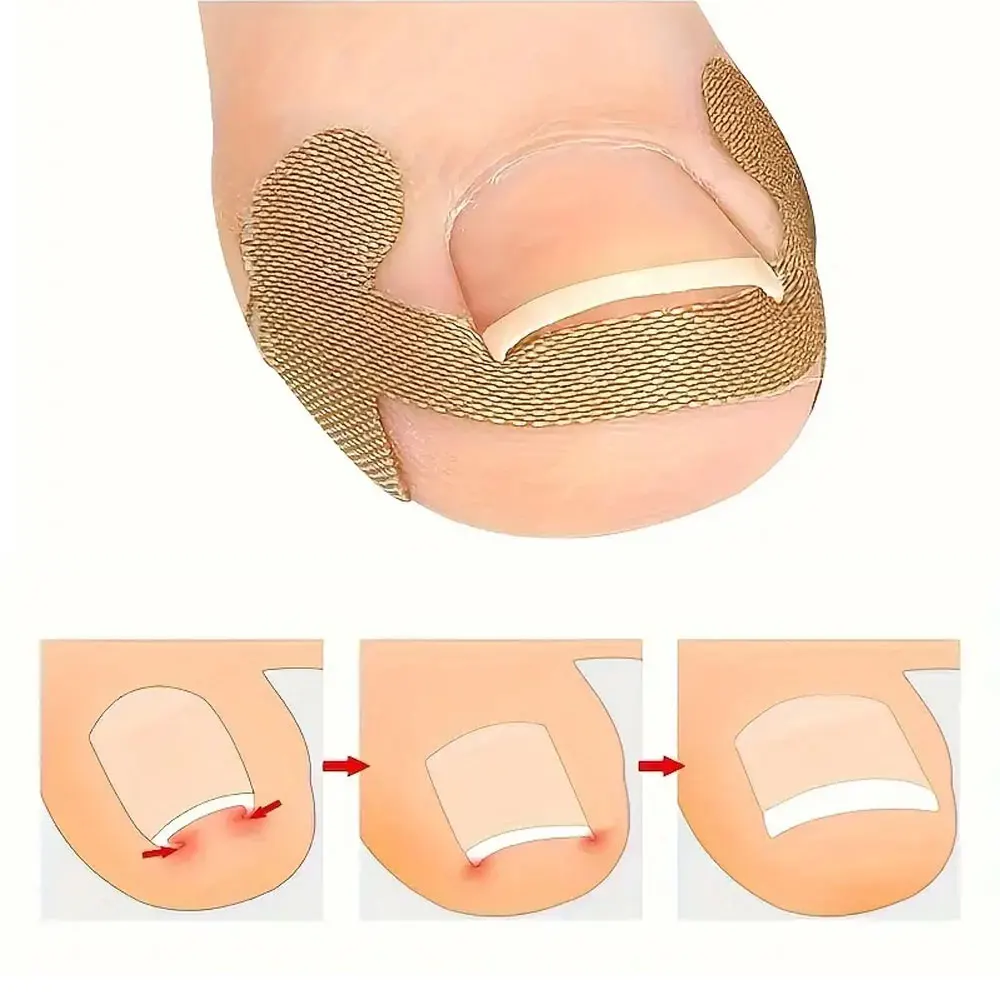 40/60/80 Uds almohadillas correctoras de uñas en línea, parches para uñas de los pies, pegatinas para uñas sin pegamento, Kit de herramientas de pedicura profesional