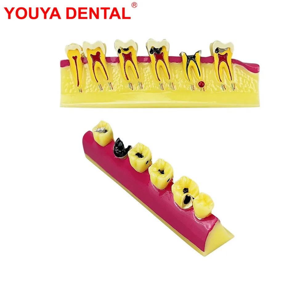 

2Time Dental Caries Model Teeth Teaching Model Periodontal Disease Decayed Tooth Model For Dentist Patient Commucation Education