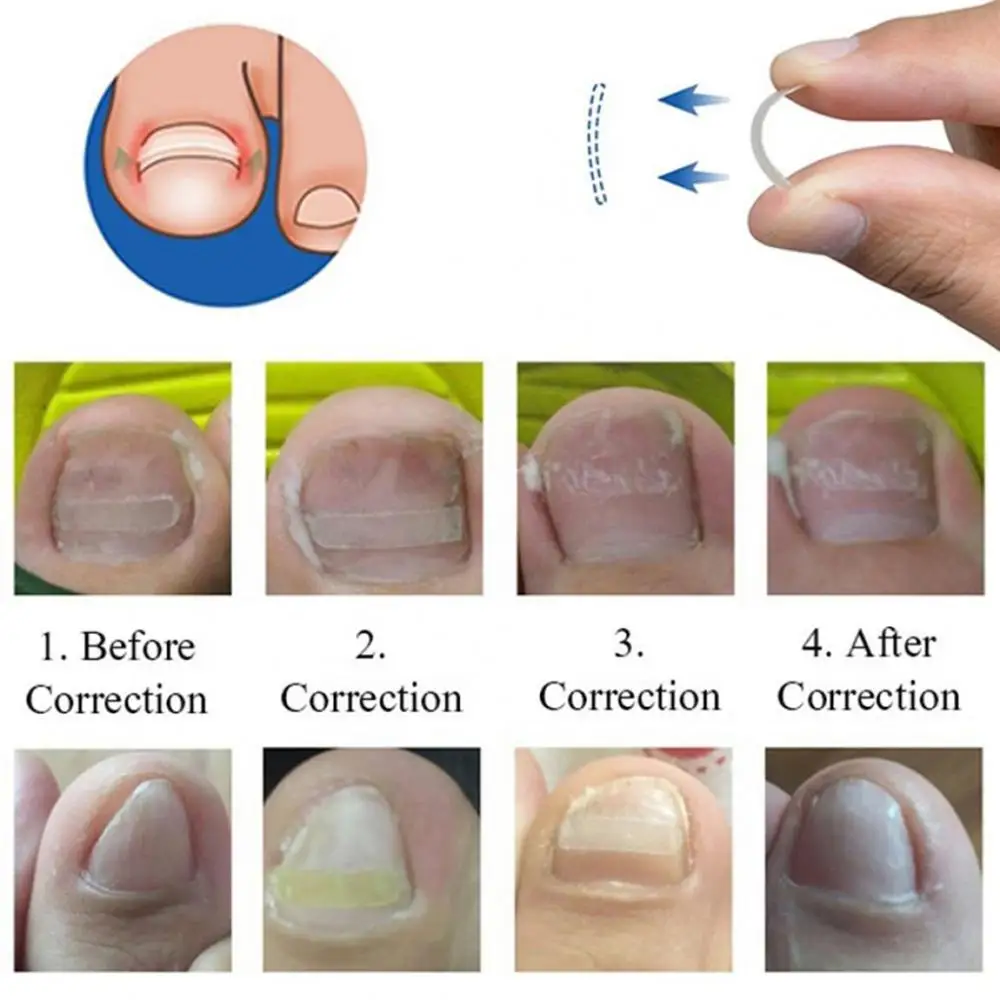 Juego de pegatinas de corrección para uñas de los pies, calcomanía curvada para enderezar encarnadas, parche elástico, herramienta para el cuidado de las uñas, manicura y pedicura, 1 a 10 piezas