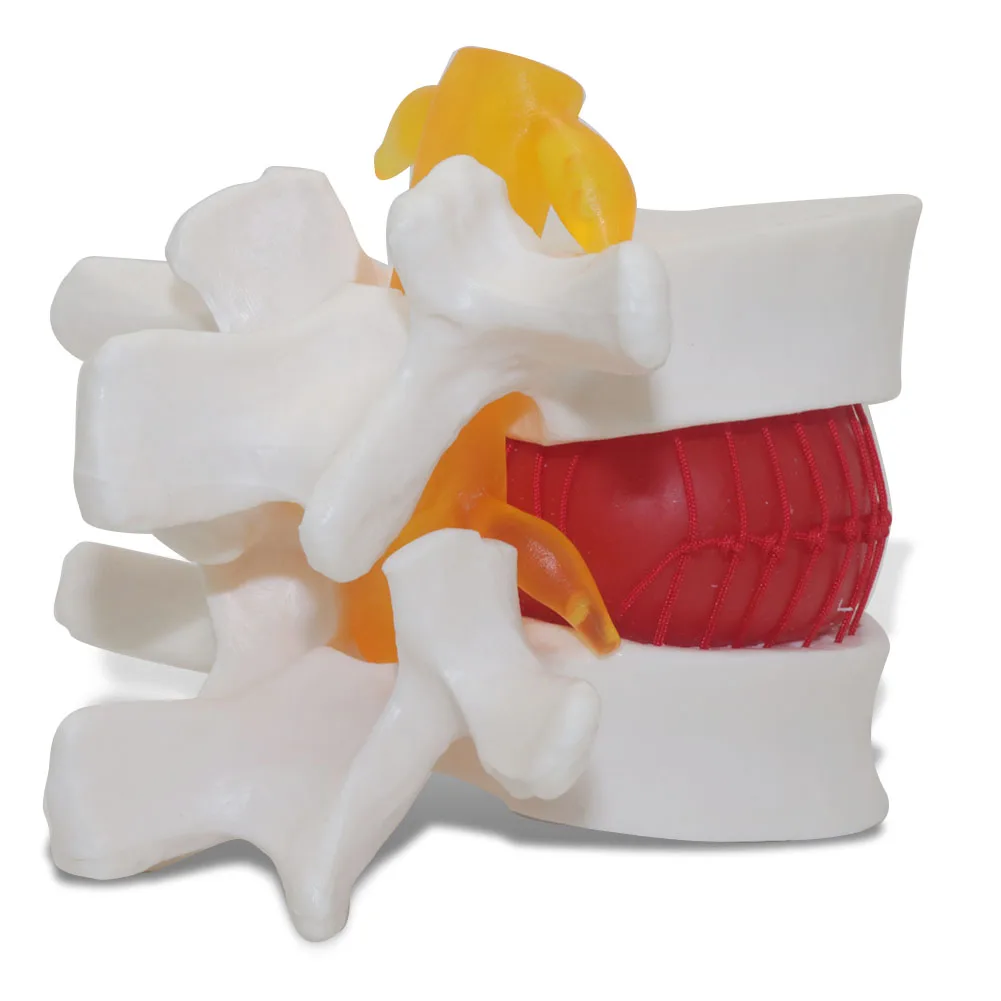 

Demonstration model of intervertebral disc herniation Medical teaching equipment model Student teaching equipment