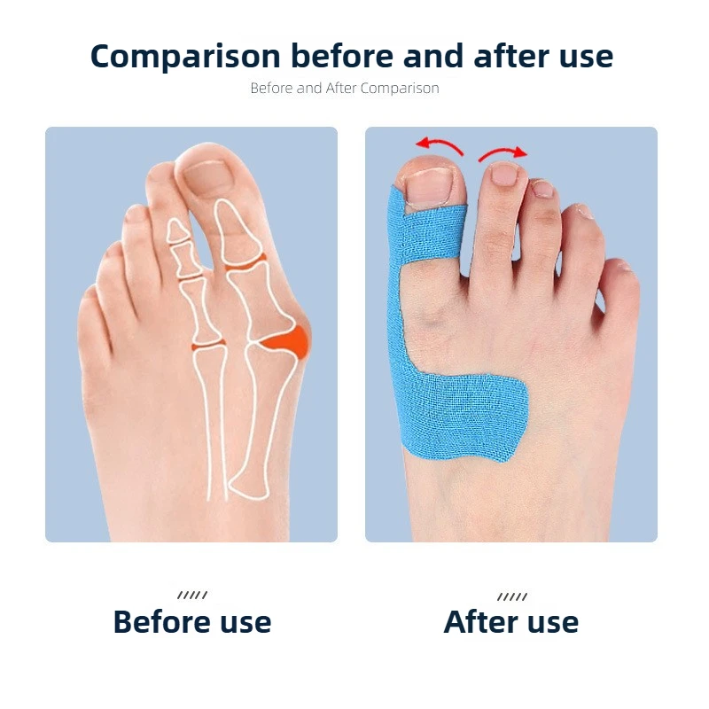 الورم مصحح العظام الورم حزام تنفس فاصل أصابع القدم أروح الجبيرة مصحح لتصحيح إصبع القدم الكبير #5