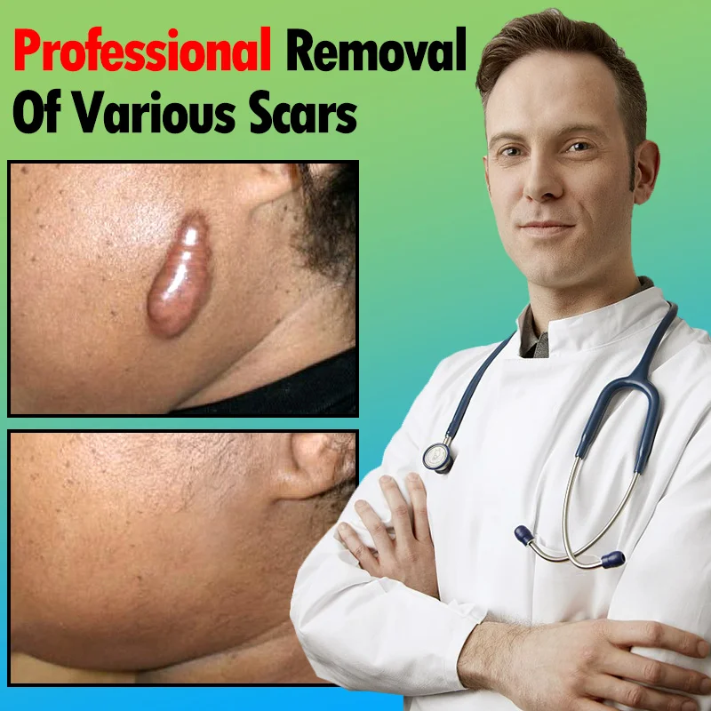 Scar Removal Stickers Repair Mepi Effectively Dilutes Cesarean Section Operation Scars Burns Scalds Scars Prevent Hyperplasia