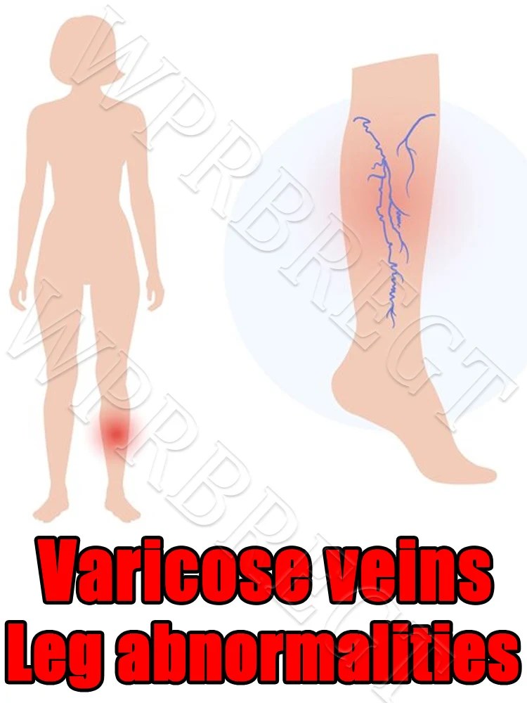 Treating varicose veins without surgery