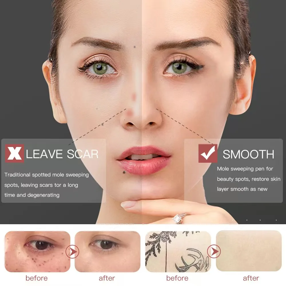 

Домашнее косметическое устройство для устранения пятен на лице